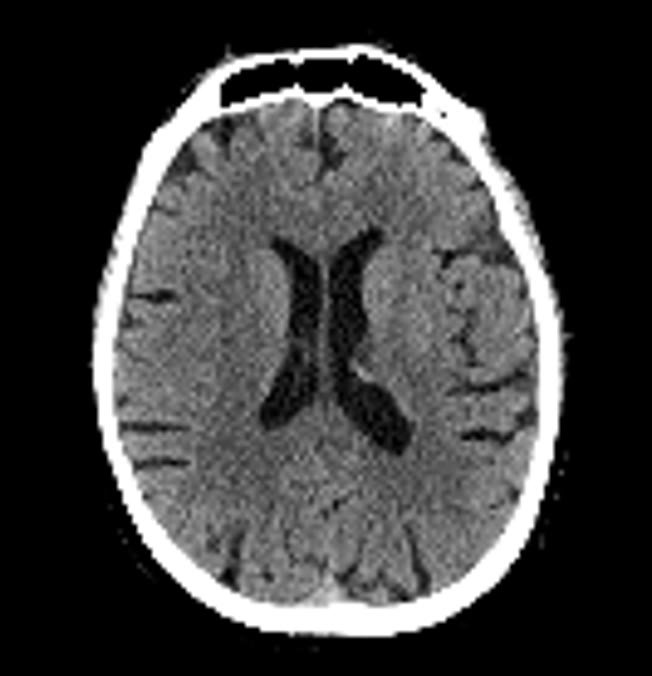 Coupe axiale de scanner de la tête, fenêtre cerveau